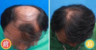 韩国毛爱林植发案例 男性秃顶植发手术效果
