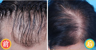 韩国毛爱林植发案例 植发手术治疗女性型脱发