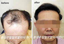 韩国黄盛柱毛发移植案例 50岁男性植发治疗秃顶