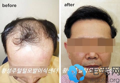 50岁老年男性在韩国黄盛柱毛发移植中心植发治疗秃顶