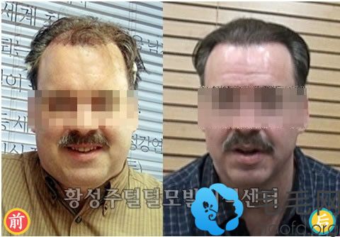 韩国黄盛柱毛发移植中心为50岁M型脱发男性进行植发治疗