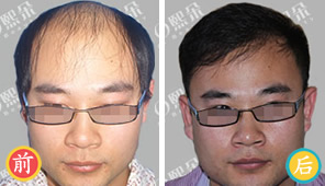北京熙朵植发案例 男性严重脱发秃顶植发效果