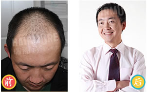 温州男性前额种植头发效果