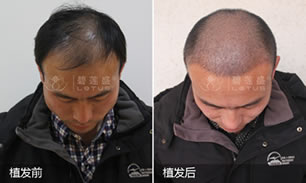 成都碧莲盛植发案例 男性头发脱掉后植发效果
