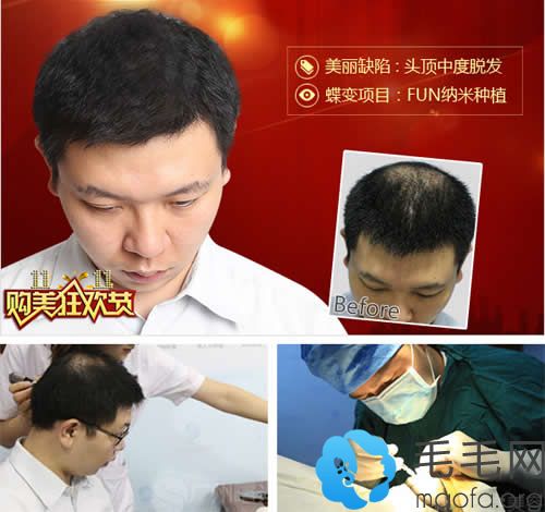 广州曙光牙科医生种植头发效果图