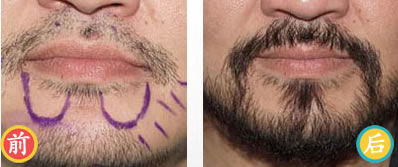 烟台华怡种植胡须真实案例 胡须男人的魅力与象征