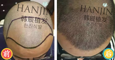 南京韩辰植发中心真实案例 摆脱男性秃顶之灾