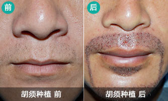 重庆迪邦胡须种植案例 男人提升气质胡须不可少
