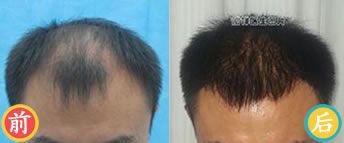 北京第三医院谢祥博士植发案例 男性五级脱发植发效果