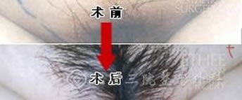 北京第三医院阴毛种植真实案例 阴毛整形注意事项