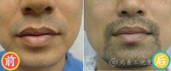 北京三院胡须移植真实案例 胡须移植效果及注意事项