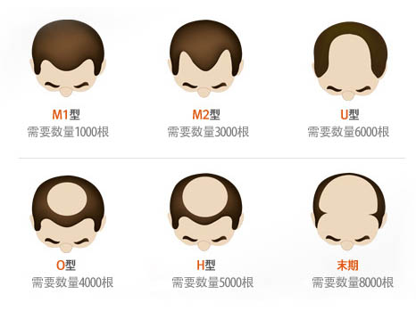 各种类型脱发需要植发的数量