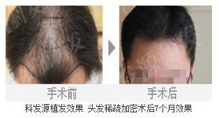 科发源植发效果 头发稀疏加密术后7个月效果