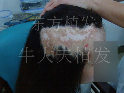疤痕植发，女孩烧伤疤痕处植发