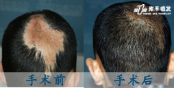 深圳雍禾植发分院 疤痕修复植发案例