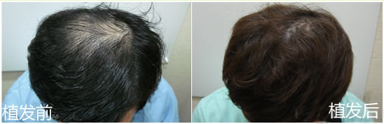 韩式植发挽救患者的雄性禿第三期末