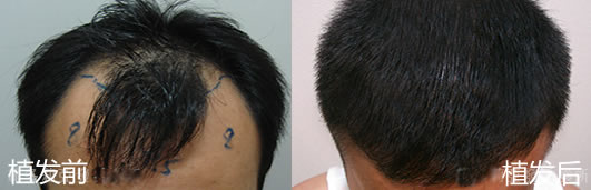 植发手术让患者的小O型雄性禿不再现