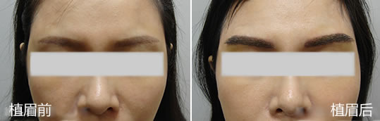女性的自然眉型 植眉术后八个月效果