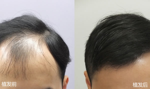 香港美丝植发中心发际线修复案例