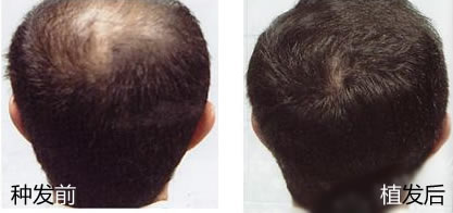 韩国毛百丽毛发移植医院种植头发的案例