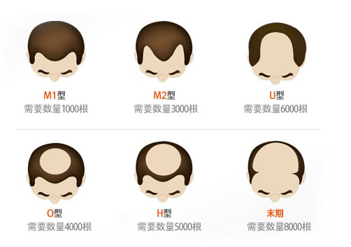 前额头发脱发程度的示意图及大致需要移植的头发数量