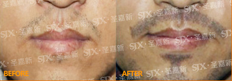 北京新生发毛发移植研究院胡须种植案例