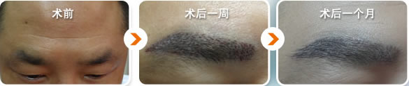 广州荔湾区人民医院毛发移植为男性植眉术后一周效果对比
