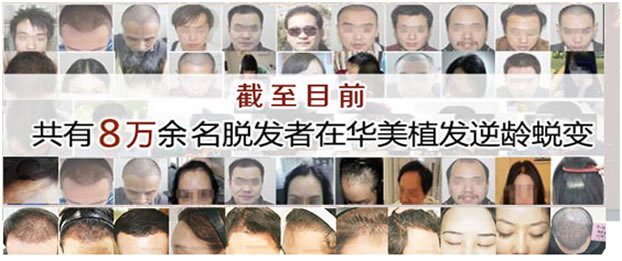 8万余名脱发者在武汉华美植发中心逆龄蜕变