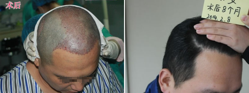 在武汉华美植发手术当天和术后八个月的效果