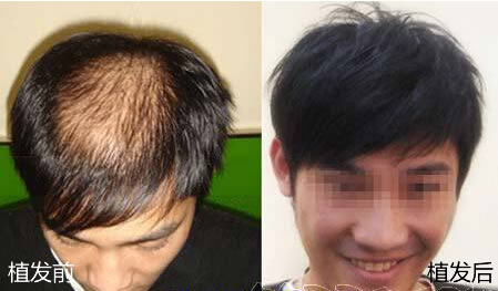 深圳仁爱医院新生植发中心帮助患者摆脱脱发