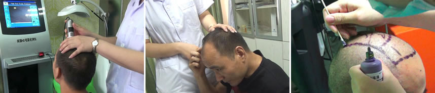 新生植发植发流程之毛囊检测诊断制定方案
