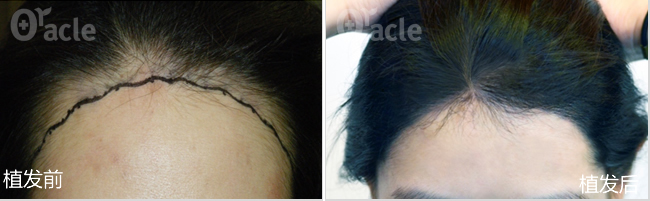 韩国奥拉克毛发移植中心女性发际线调整效果对比图