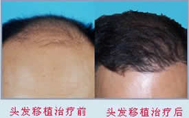 上海艺星毛发移植中心男性毛发移植术前术后效果对比