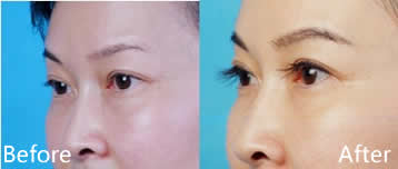 上海艺星毛发移植中心成功种植睫毛手术前后效果对比