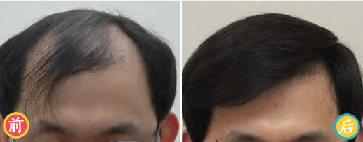 上海美莱毛发移植中心秃顶植发案例 FUE+SHT远离秃顶危机