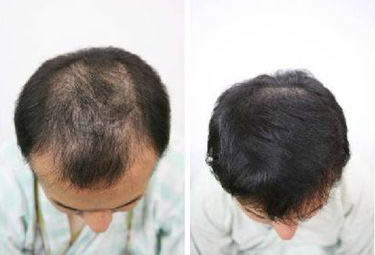 北京八大处夏炜教授毛发移植案例 摆脱秃顶不是梦