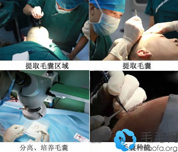 重庆时光种植发际线手术过程图
