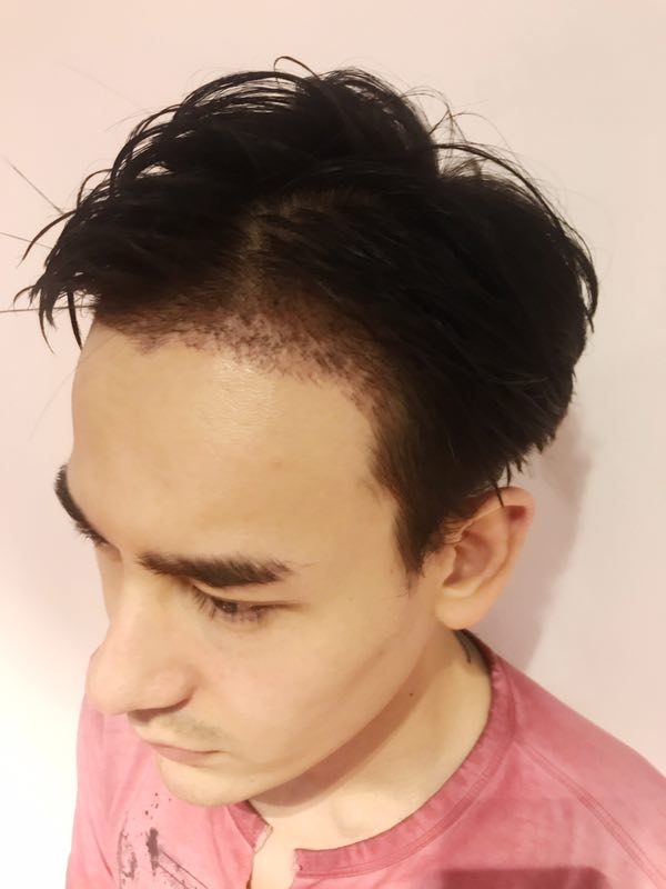 成美植发中心男性种植发际线15天效果