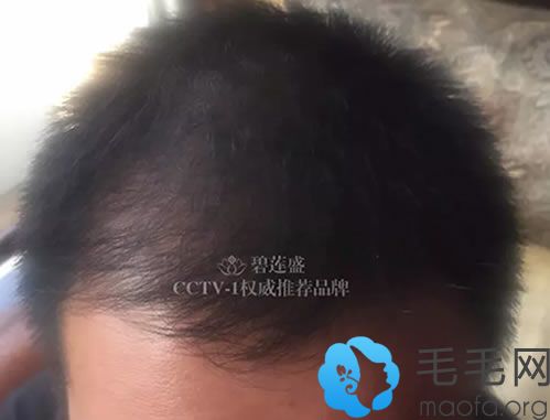 王先生植发4个月的头顶照片