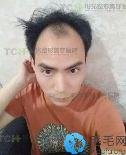 刘先生植发前的照片