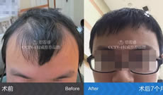 三级脱发的小君分享在碧莲盛植发2200单位7个月恢复效果图