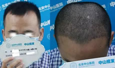 看39岁陈先生三级脱发在北京中山植发3个月恢复效果怎么样