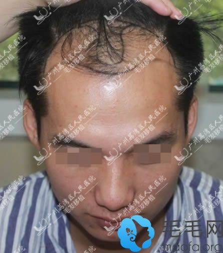 植发案例：在广州荔湾区人民医院种植头发5个月恢复效果图
