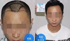 杜先生分享在上海雍禾植发种植头发五个月的恢复效果
