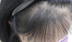 发际线种植案例：北京雍禾让产后脱发“裘千尺”变美人