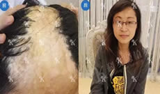 上海科发源医院疤痕植发真实案例及一年后恢复效果