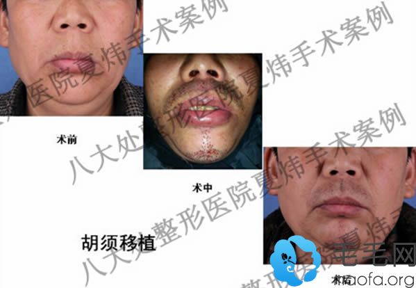 北京八大处植发中心胡须种植前后对比效果
