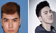 北京熙朵李会民植发怎么样？头发种植案例对比图告诉你