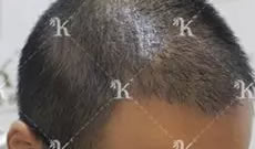 郑州科发源植发怎么样 男士种植头发5个月后成功摆脱秃顶