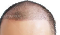 秃顶男士在成都丝缘植发进行头发种植后终于看到希望